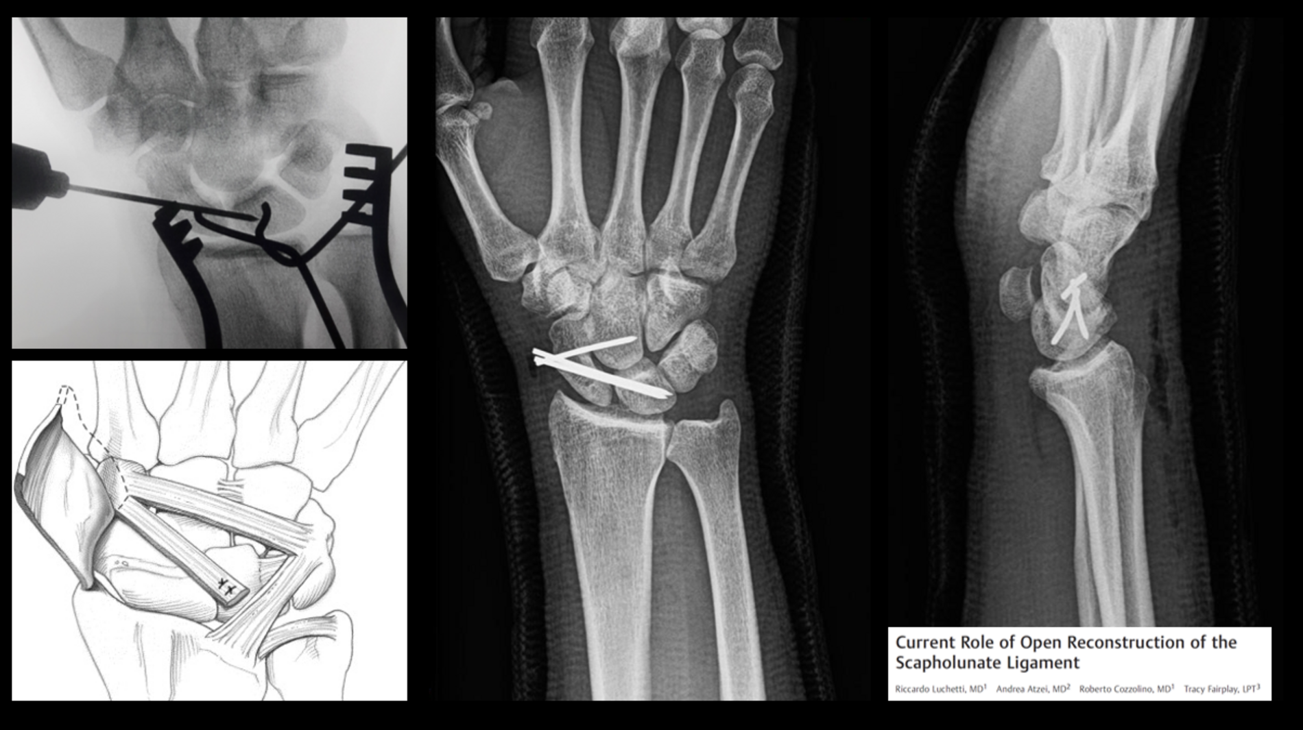Scafo lunaire Dissociatie Orthoclinic Orthopedie Brugge scafo-lunaire-dissociatie-orthoclinic-orthopedie-brugge